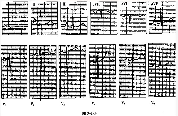 心电学技术(主管技师):心房肥大和心室肥大心电